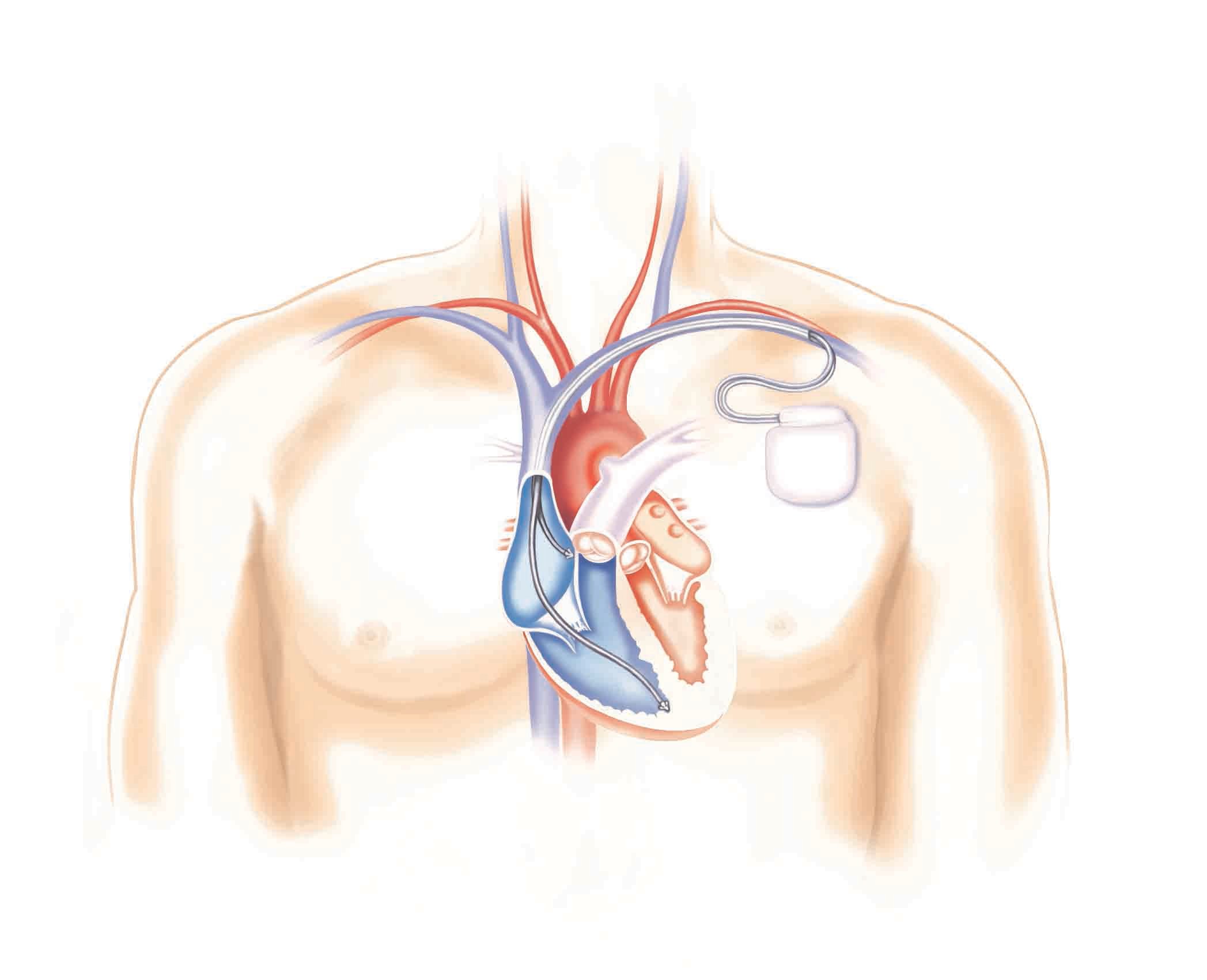 En inopererad defibrillator kallas också ICD efter den engelska förkortningen Implantable Cardioverter Defibrillator.
